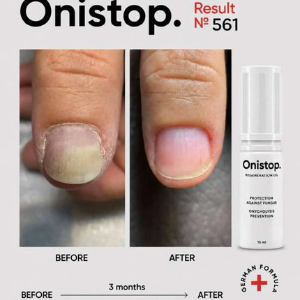 Regenerativno olje proti oniholizi - OniStop 15ml NAILSOFTHEDAY