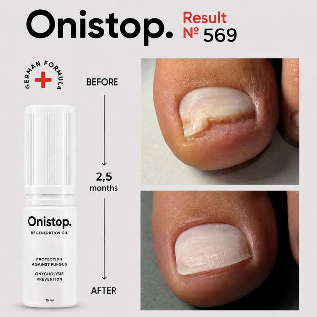 Ulei regenerant împotriva onicolizei - OniStop 15ml NAILSOFTHEDAY