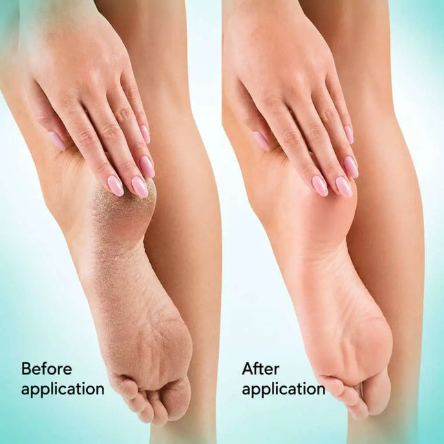 Gel queratolítico para uso local Soft Blade Shelly 100 ml